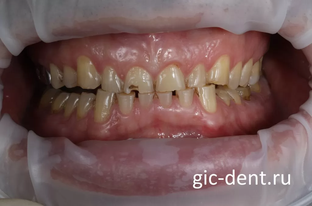 Среди последствий ночного скрежета зубами отмечается истирание твердых тканей зубов